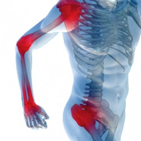 Sąnarių skausmas vystantis artritui