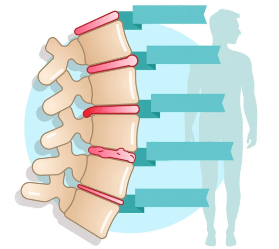 Krūtinės ląstos osteochondrozės ligos laipsnis