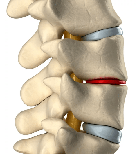 krūtinės ląstos stuburo osteochondrozė