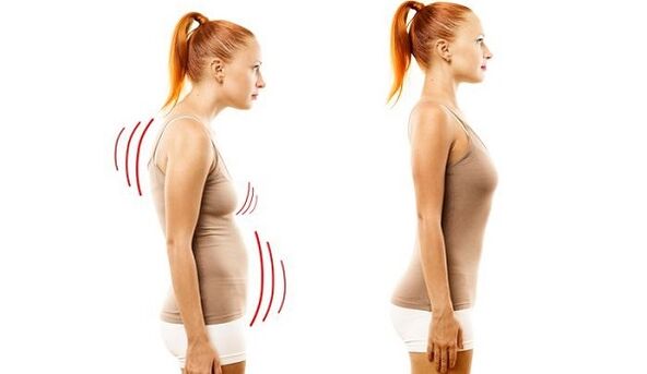 tiesi nugara ir bloga laikysena sergant gimdos kaklelio osteochondroze