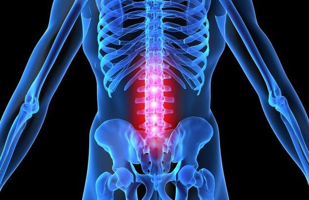 Pažengusioje juosmeninės stuburo dalies osteochondrozės stadijoje pablogėja žmogaus motorinė veikla. 
